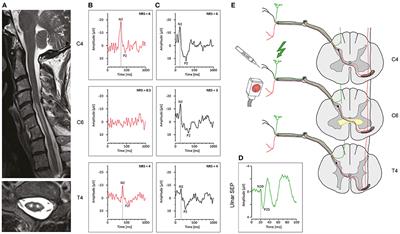 Not Hot, but Sharp: Dissociation of Pinprick and Heat Perception in Snake Eye Appearance Myelopathy